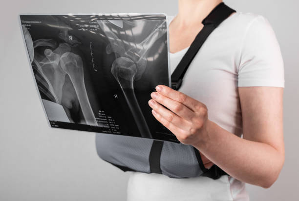Recuperarea după fractura de humerus nu trebuie să fie dureroasă – ci blândă și progresivă